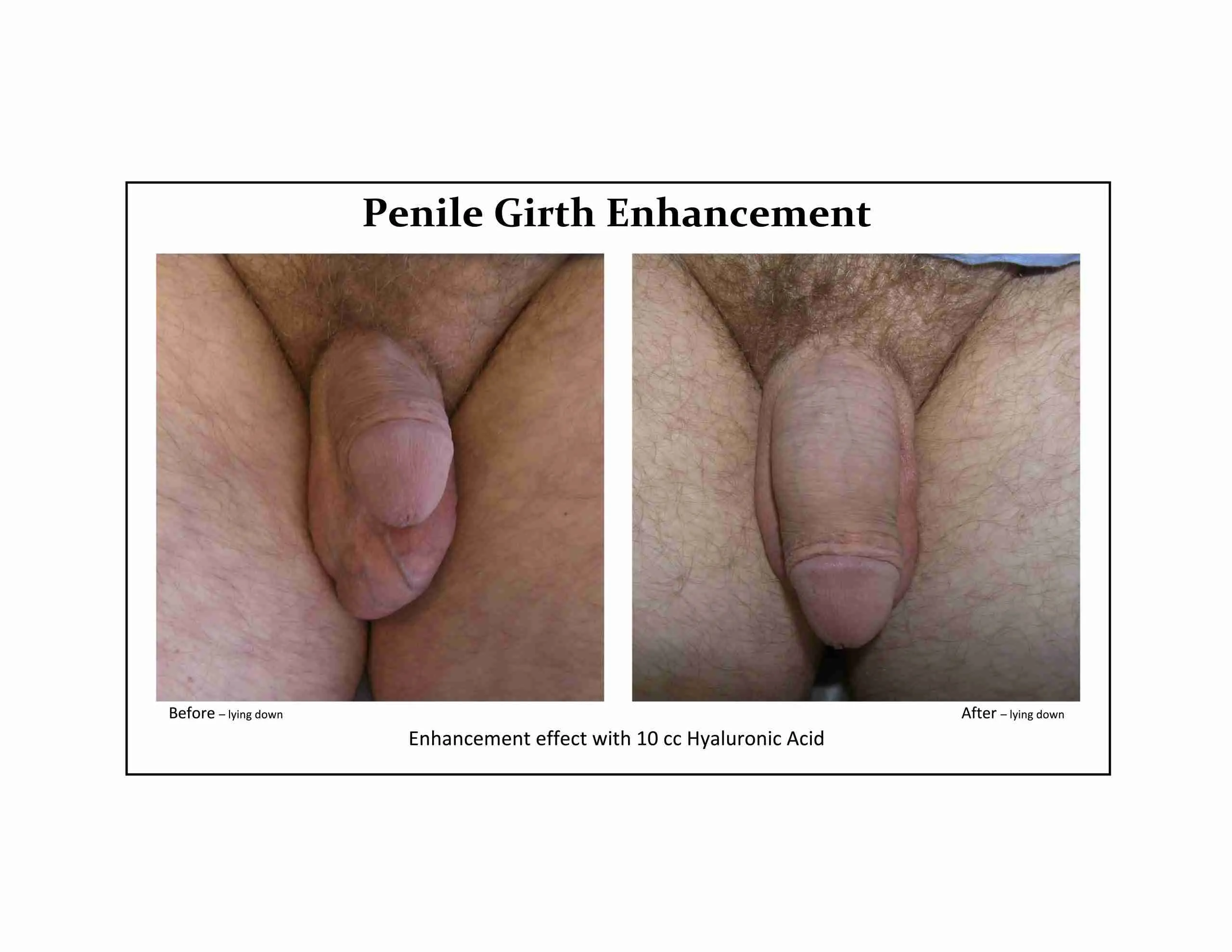 Before and after HA filler girth enhancement result