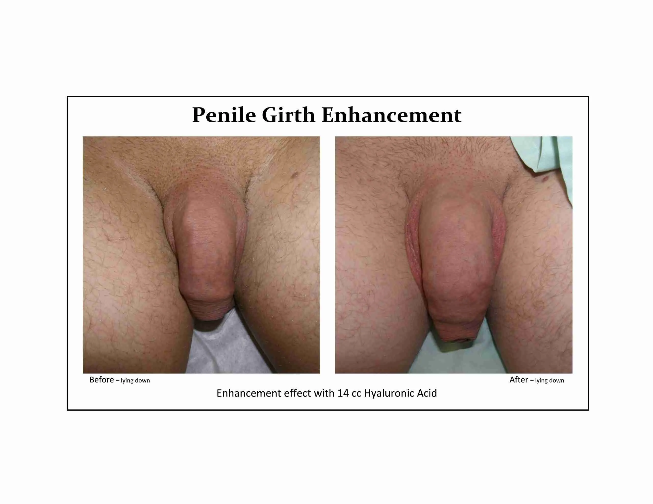 Before and after penile girth enhancement example