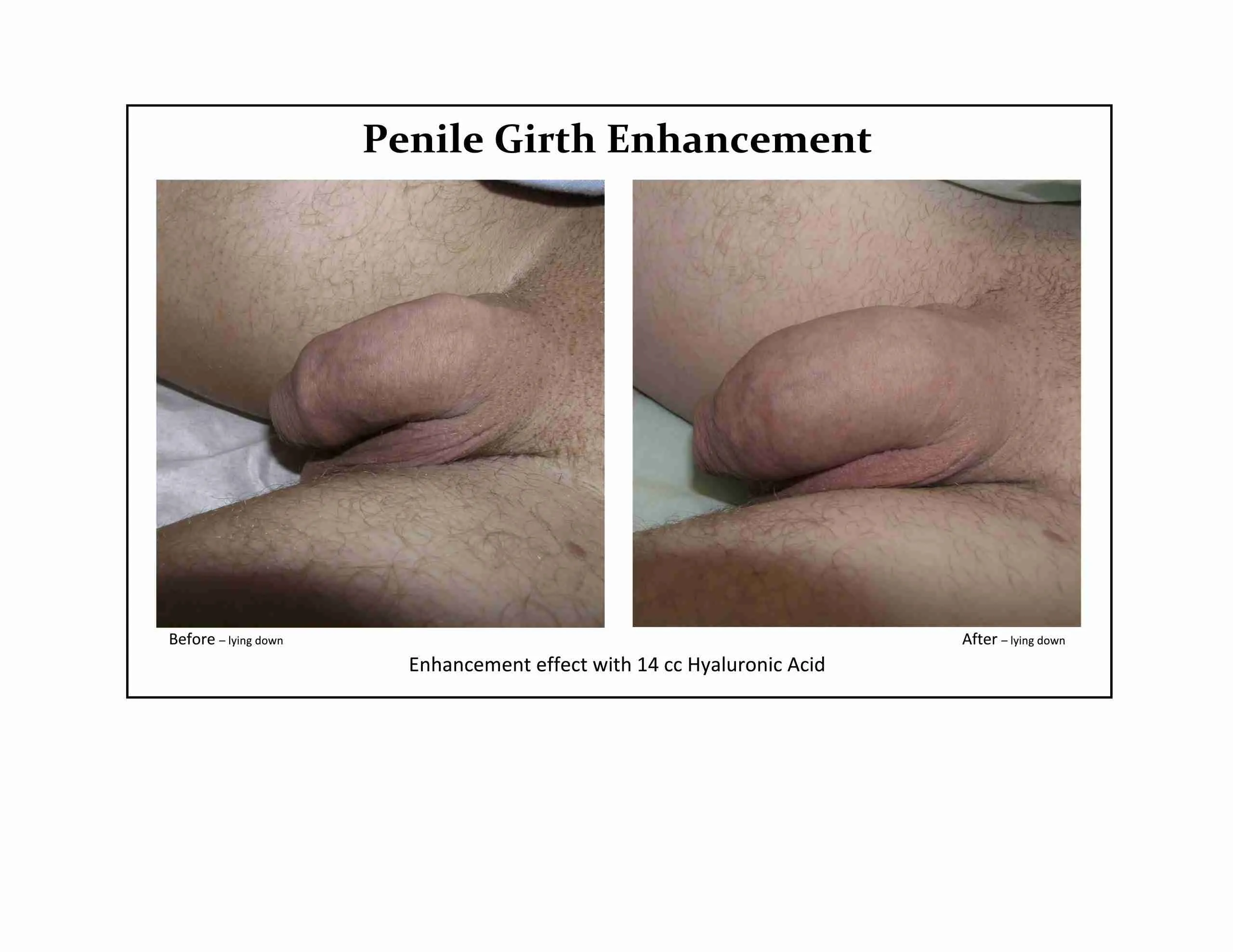 Before and after penile girth enhancement result treated by Dr. Nel