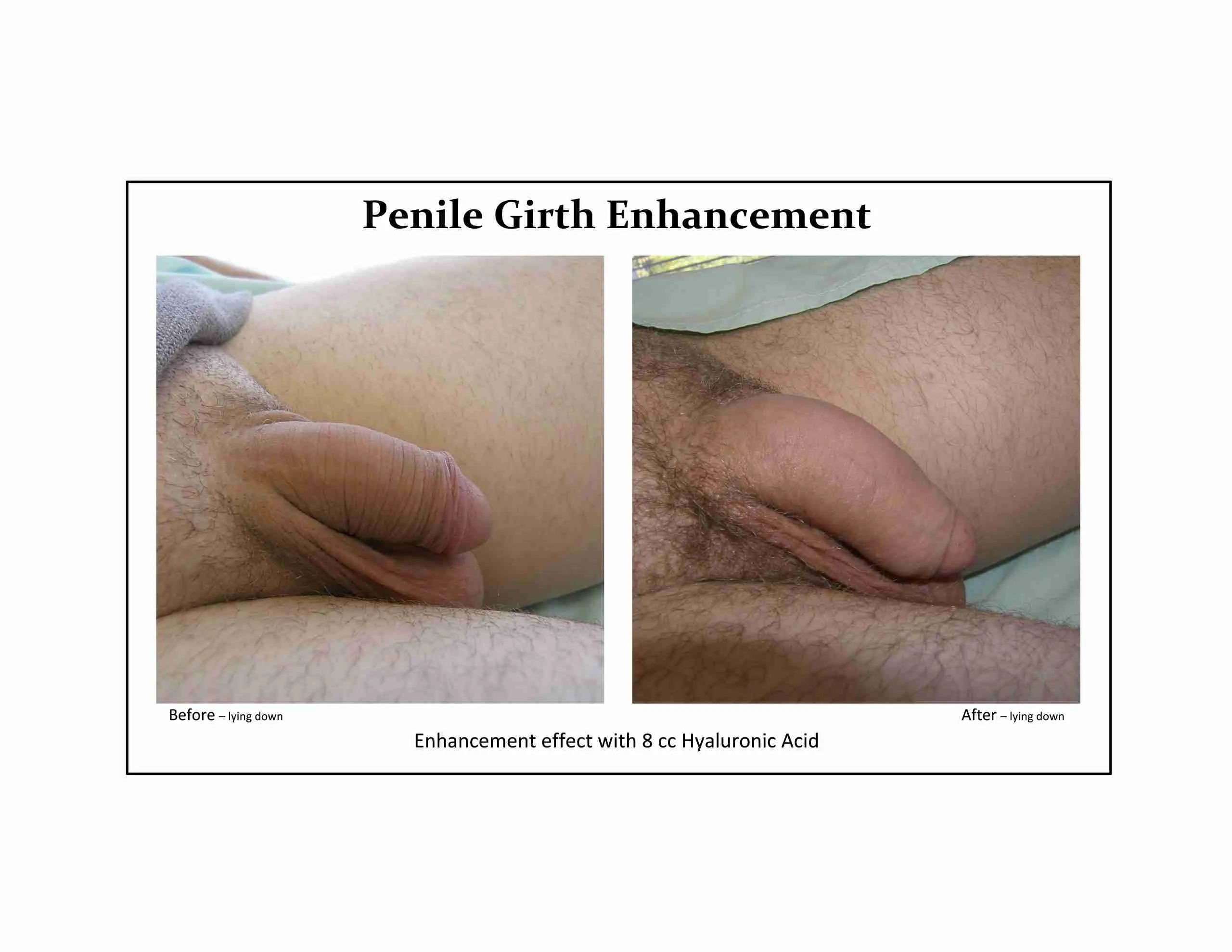 Before and after penile filler result