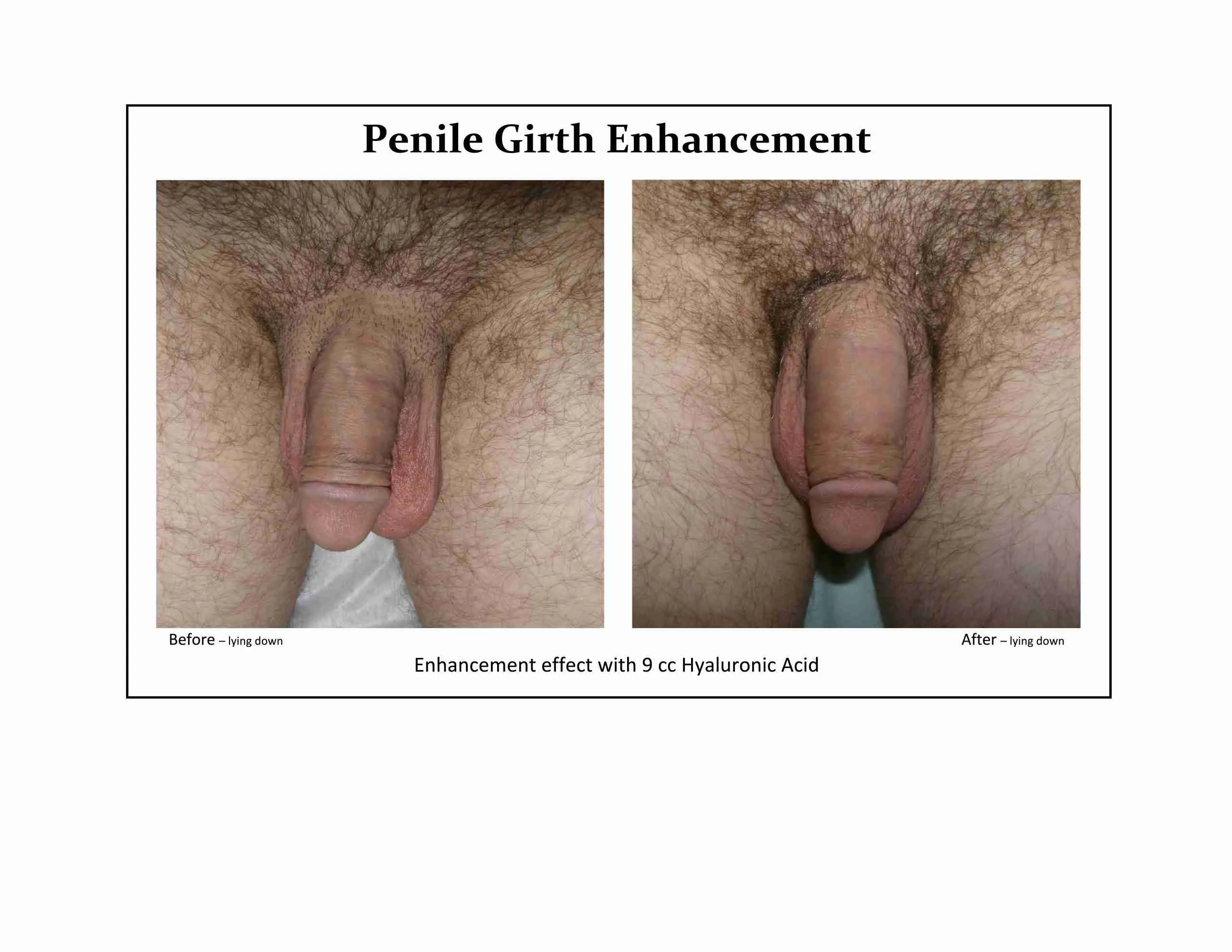 Before and after non-surgical penile girth enhancement result